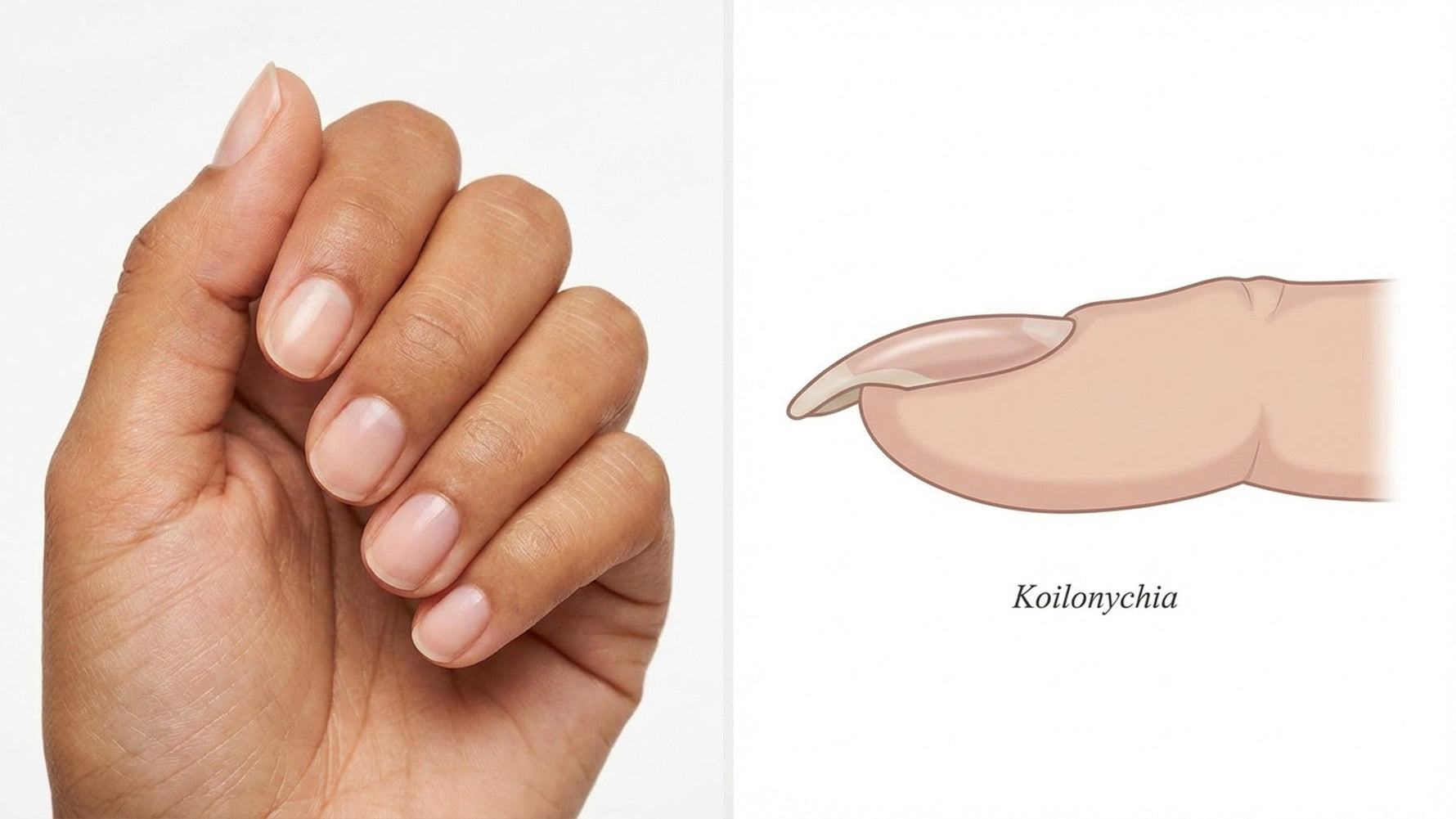 Why Do My Nails Curve Down? Causes & What You Can Do hero image